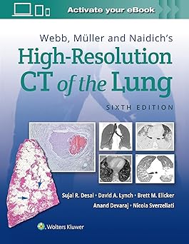 Webb, Müller and Naidich's High-Resolution CT of the Lung Sixth Edition